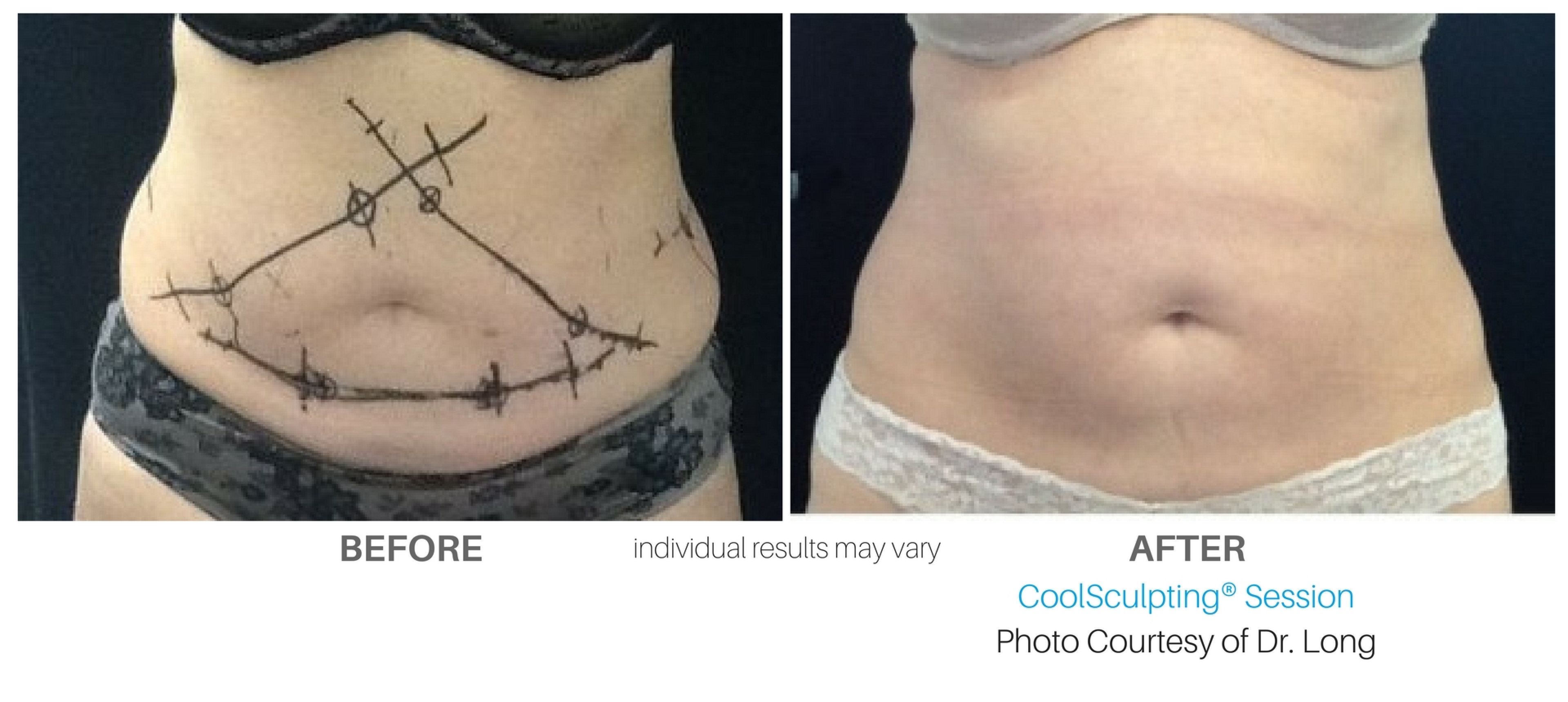 CoolSculpting Cincinnati FREEZE YOUR FAT!